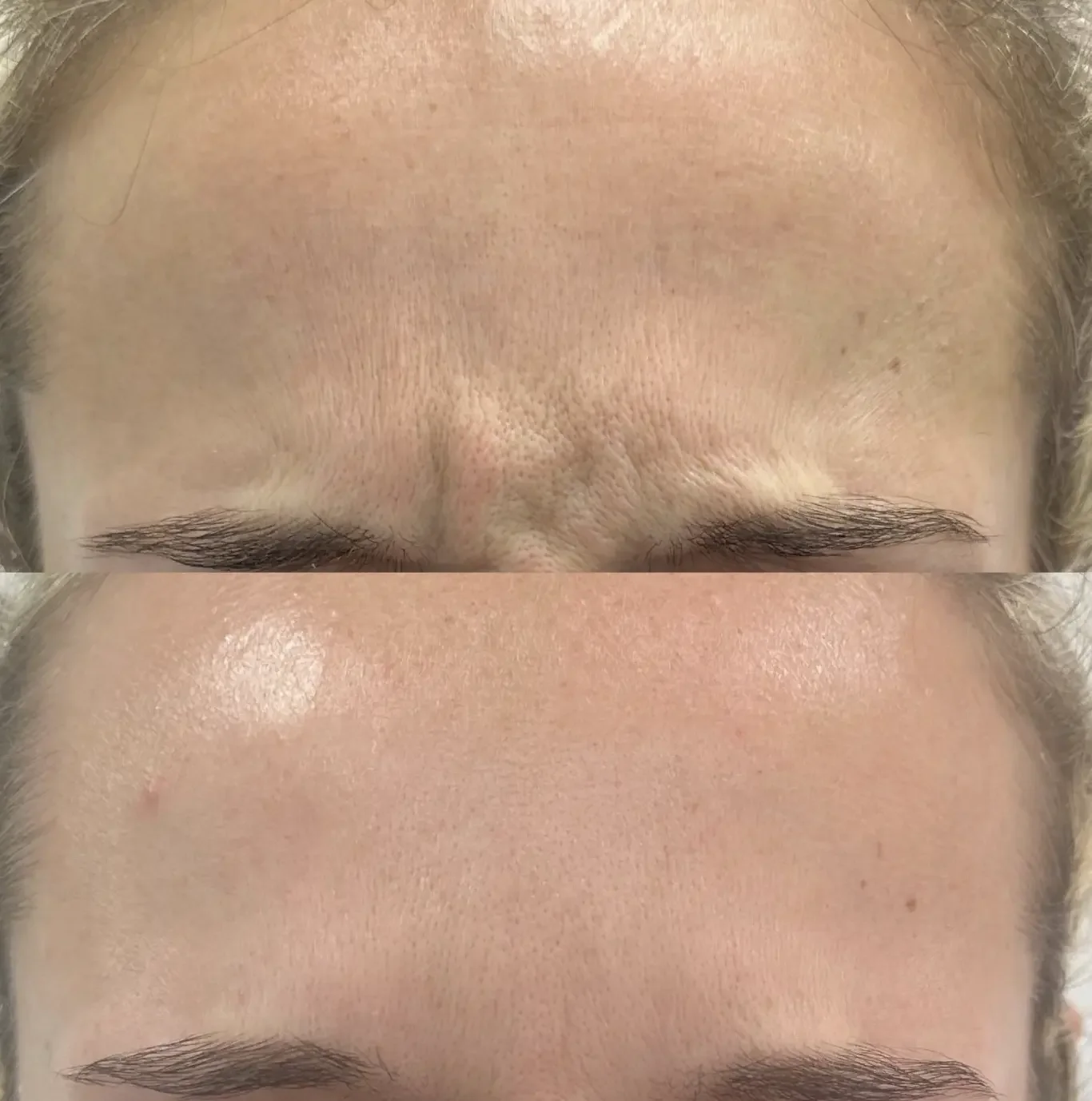 Anti-wrinkle injection treatment