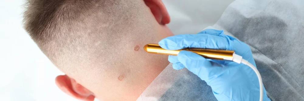 Cryotherapy for skin tags and benign lesions