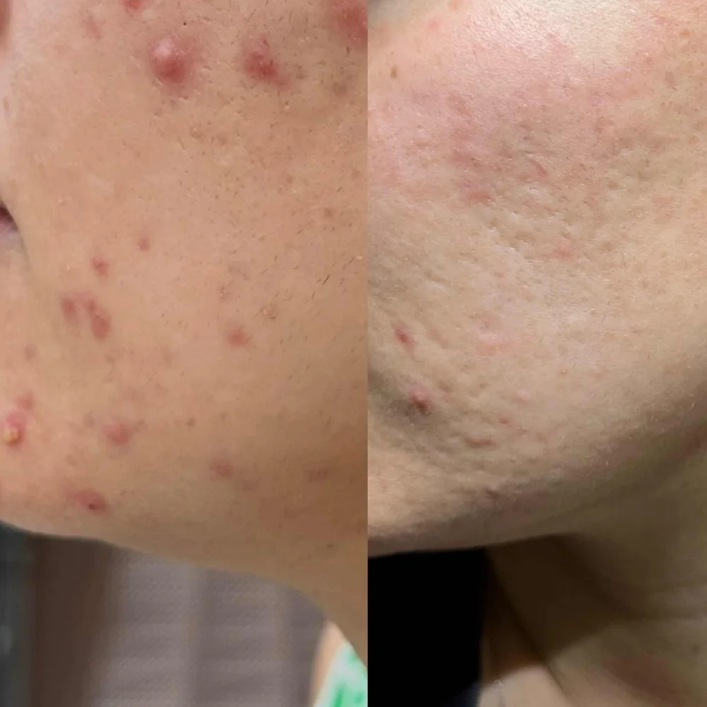 Acne treatment before and after
