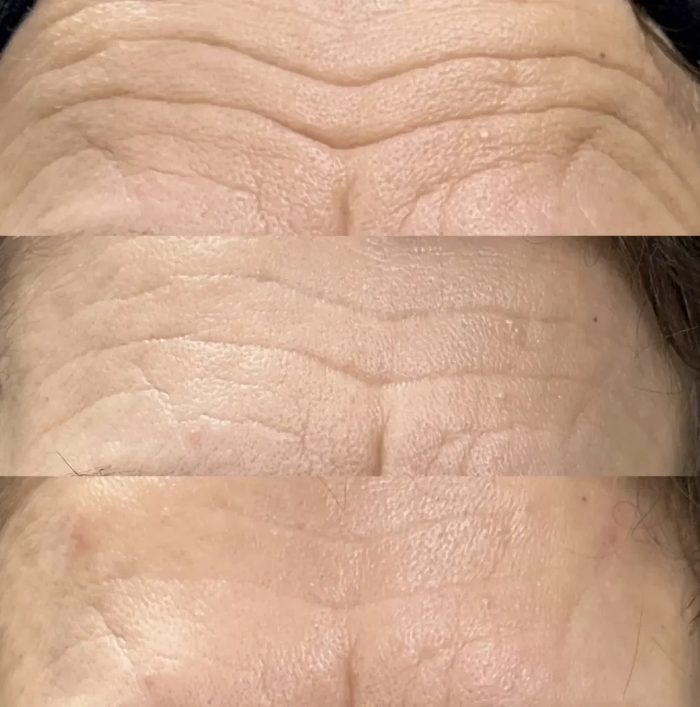 Anti-wrinkle treatment at Aesculus Clinic