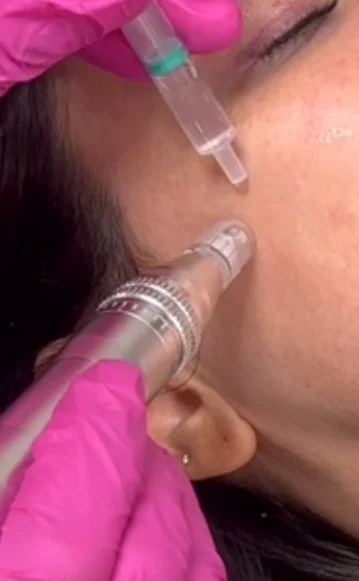 Microneedling treatment in New Malden