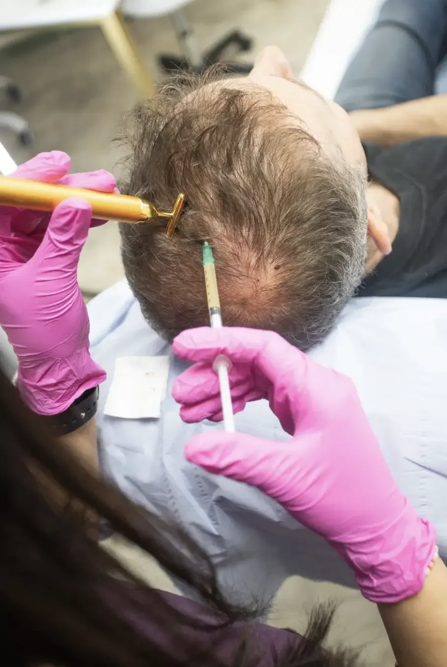 PRP treatment for hair loss